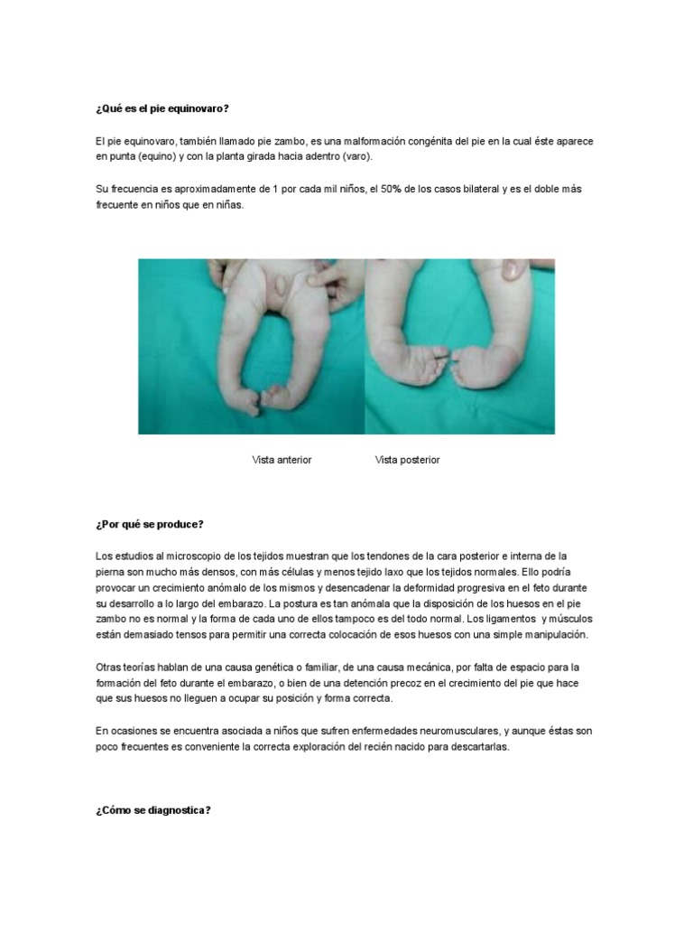Qué Es El Pie Equinovaro PDF Pie El embarazo