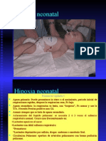 Hipoxia neonatal