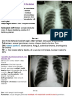 Berdasarkan ciri-ciri yang ditampilkan pada x-ray polos abdomen posisi LLD, diduga terdapat ileus mekanik akibat obstruksi usus halus