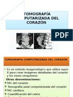 Tomografía Computarizada Del Corazón
