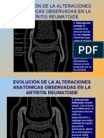 artritis reumatoide + sd sjoegren