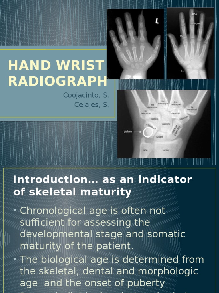 Hand-Wrist Radiograph for Skeletal Maturity | PDF | Hand ...