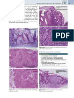 Inflamed Seborrheic Keratosis: Key Features