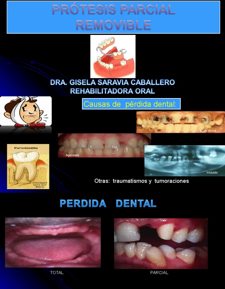 Clasificacion de Kennedy y Apllegate Human Tooth Dentistry