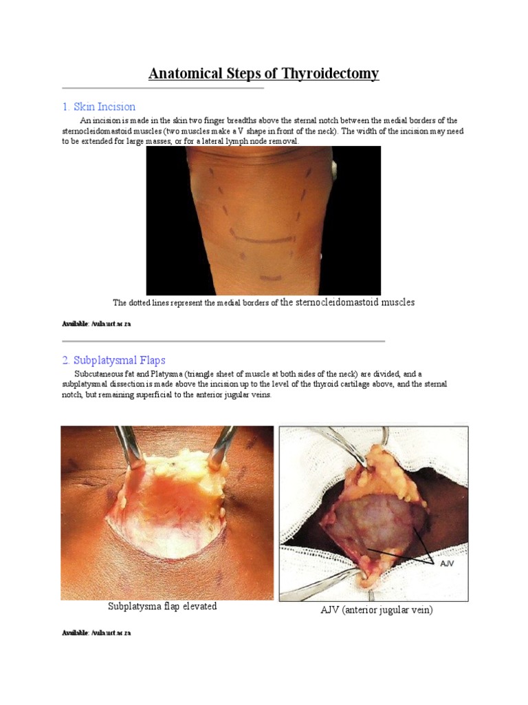 Anatomical Steps in Thyroidectomy | PDF | Thyroid | Neck