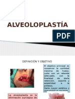 Alveoloplastia-Final.pptx