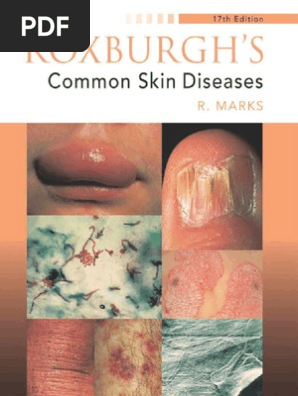 Roxburgh Common Skin Diseases Pdf Epidermis Cutaneous Conditions
