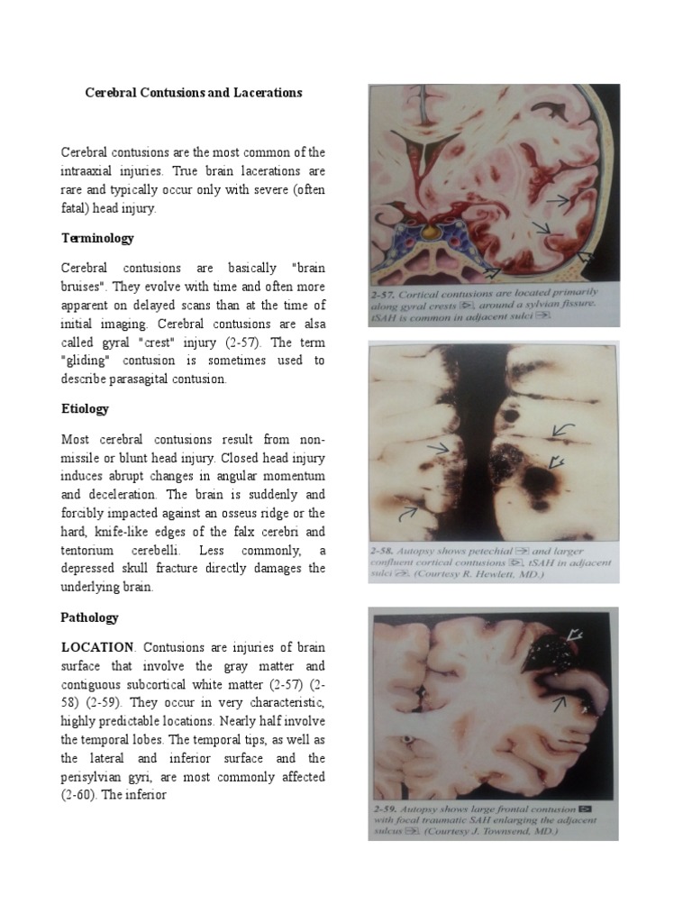 Cerebral Contusions and Laceration Traumatic Brain Injury Human