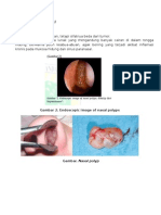 THT - Polip Hidung