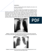 Tanda Radiografi Pada Pneumothorax