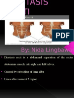 Diastasis Recti