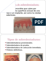 Definición y tipos de sobredentaduras e implantes