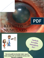 Keratitis Numularis