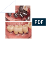 Rehabilitation of The Atrophic Posterior