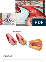 Alter o Sclerosis