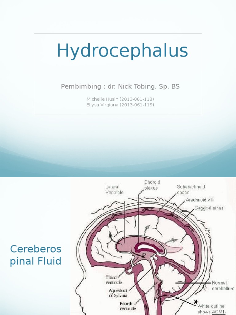 Hydrocephalus | Download Free PDF | Cerebrospinal Fluid | Human Head ...