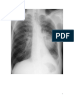radiografii cancer bronhopulmonar.doc