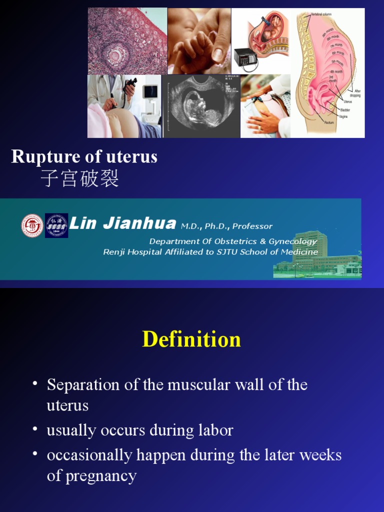 Uterine Rupture: Causes & Treatment | PDF
