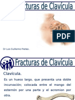 Fractura Clavicular