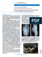 Un caso de Fetus in fetu