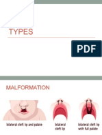 Cleft Lip and clip Palate