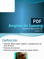 Angina de Ludwig: infección severa y mortal de origen dental