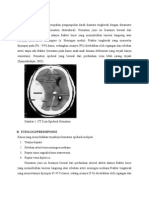 Epidural Hematoma