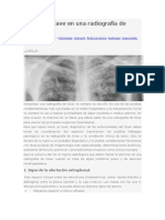 10 Signos Clave en Una Radiografía de Tórax