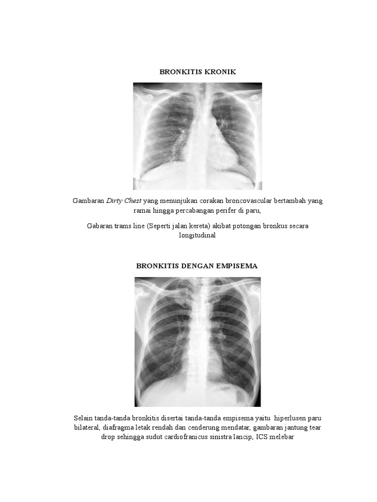 Resumme Bronkitis Dan Bronkiektasis | PDF | Sejarah