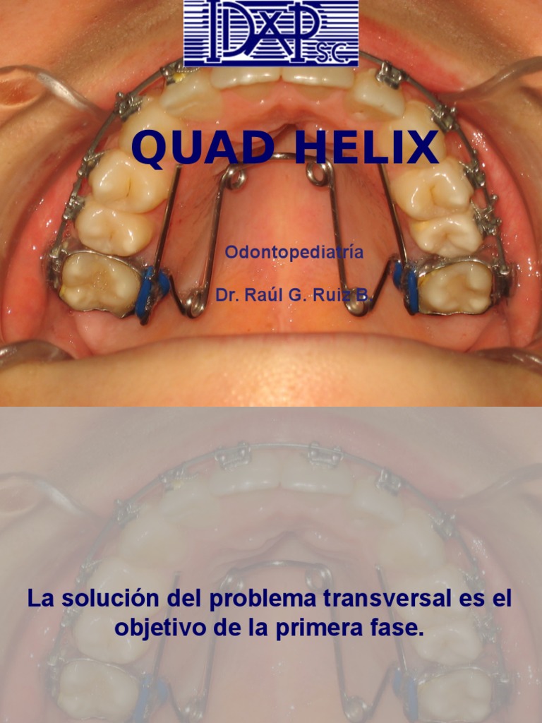 Quad Helix Odontopediatría Dr. Raúl G. Ruiz B Naturaleza