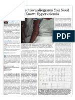 Ecg Hyperkalemia