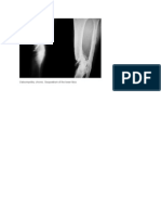 Gambar Osteomielitis