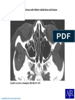 72-Year-Old Man With Inferior Orbital Blow-Out Fracture: Erly, W. K. Et Al. Am. J. Roentgenol. 2003 180:1727-1730