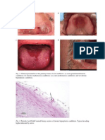 Fig. 1. Clinical Presentation of The Primary Forms of Oral Candidosis. (A) Acute Pseudomembranous