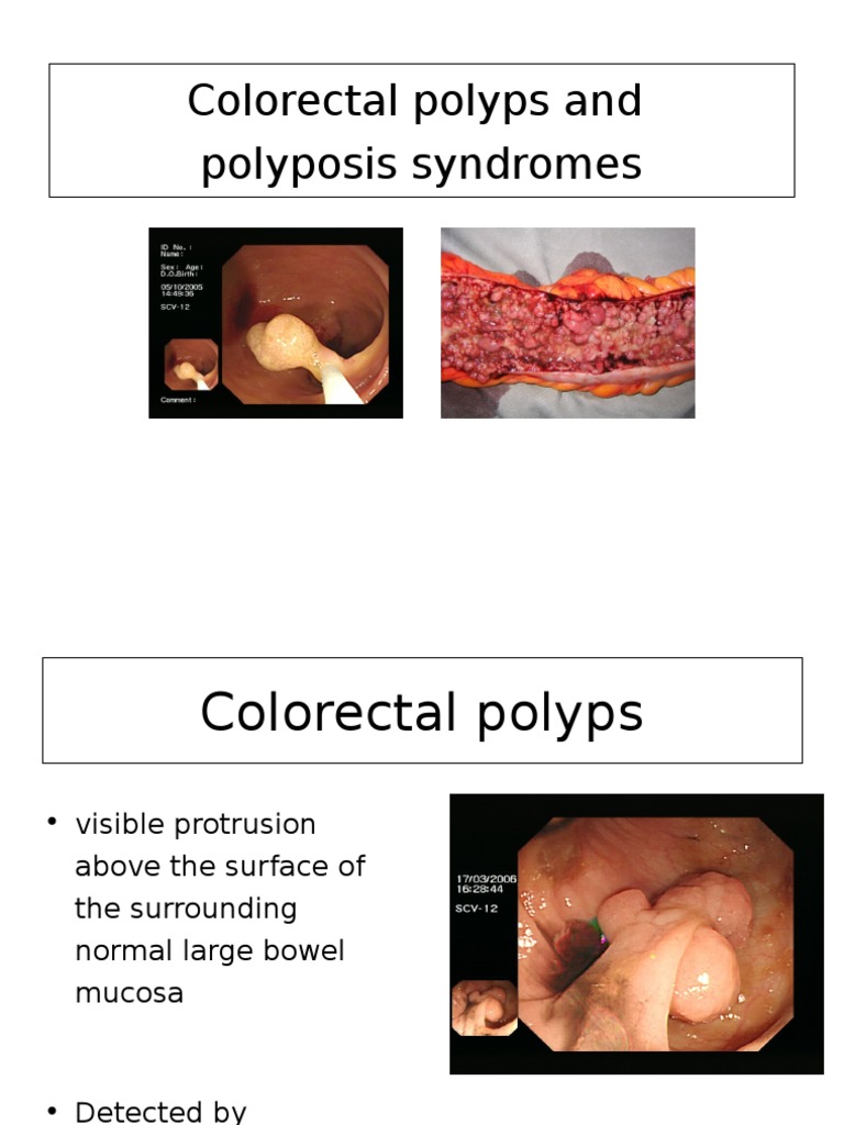 Polyps and Polyposis | PDF | Adenoma | Colorectal Cancer