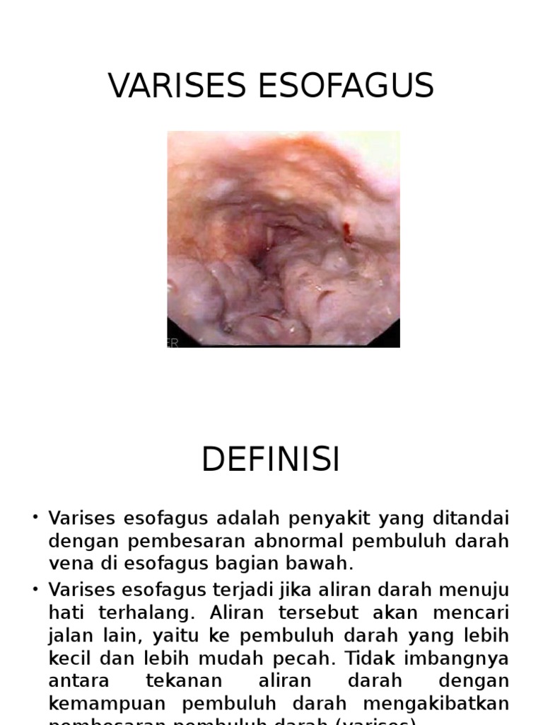Penyakit dan Penanganan Varises Esofagus | PDF | Memasak, Makanan, & Anggur