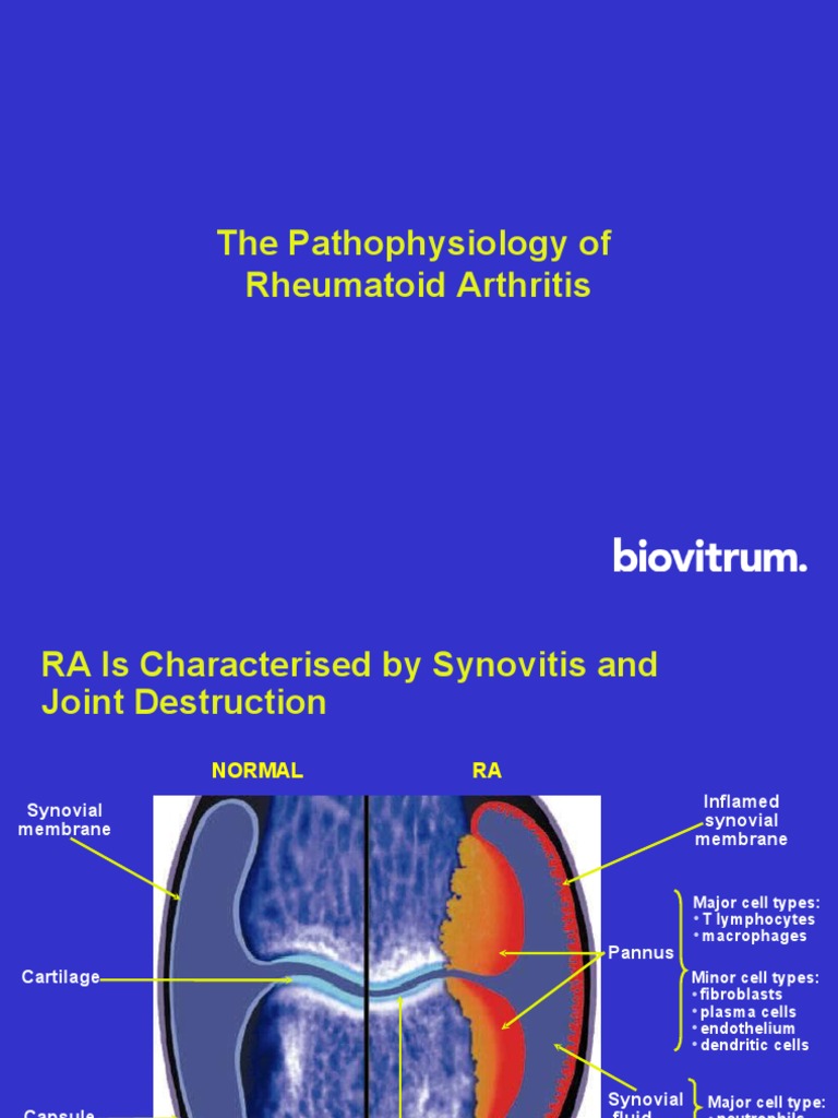 Pathophysiology of Rheumatoid Arthritis | PDF | Inflammation ...
