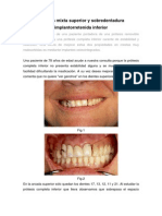 Implantes y Ataches Caso Clinico