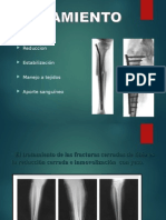 Fracturas Diafisiarias de Tibia