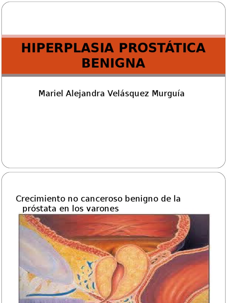 HIPERPLASIA PROSTATICA BENIGNA.ppt Cancer de prostata