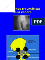 05- Luxaciones de La Cadera