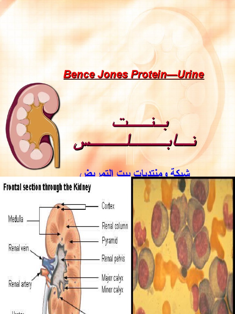 Bence Jones Protein—Urine(1).ppt Multiple Myeloma Kidney
