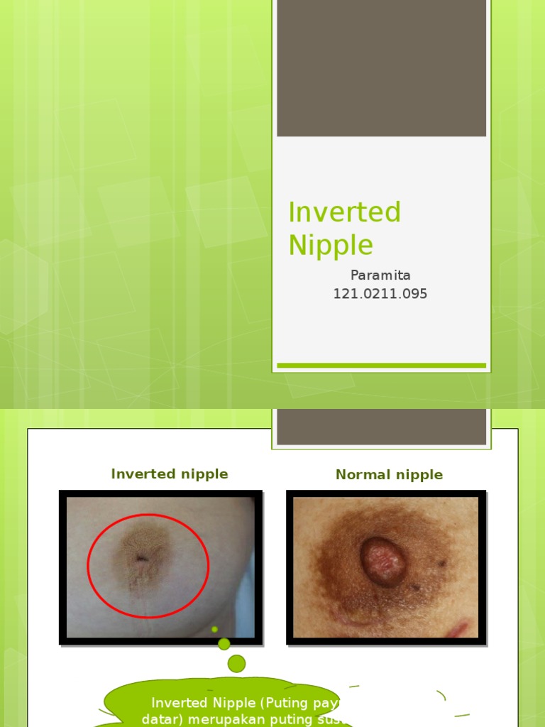 Inverted Nipple PDF