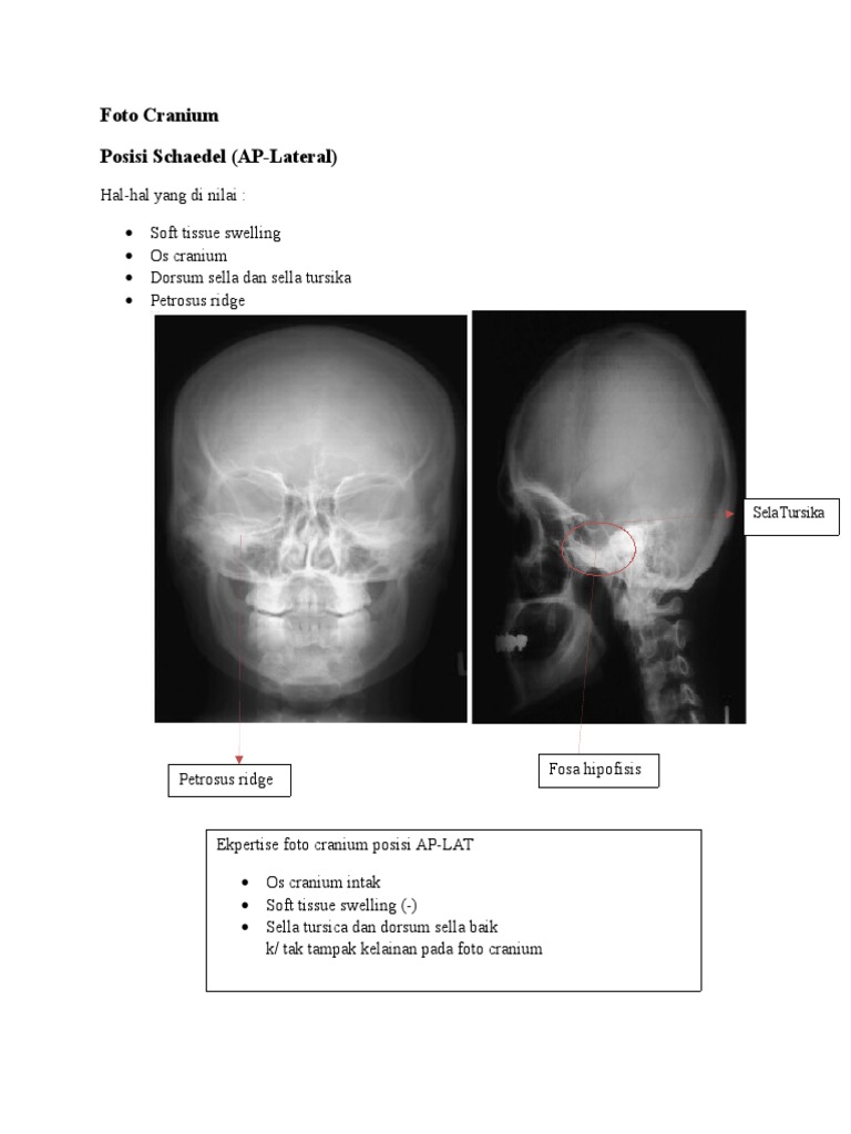 Rontgen Kepala AP-Lateral dan Analisis | PDF