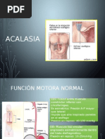 Acalasia