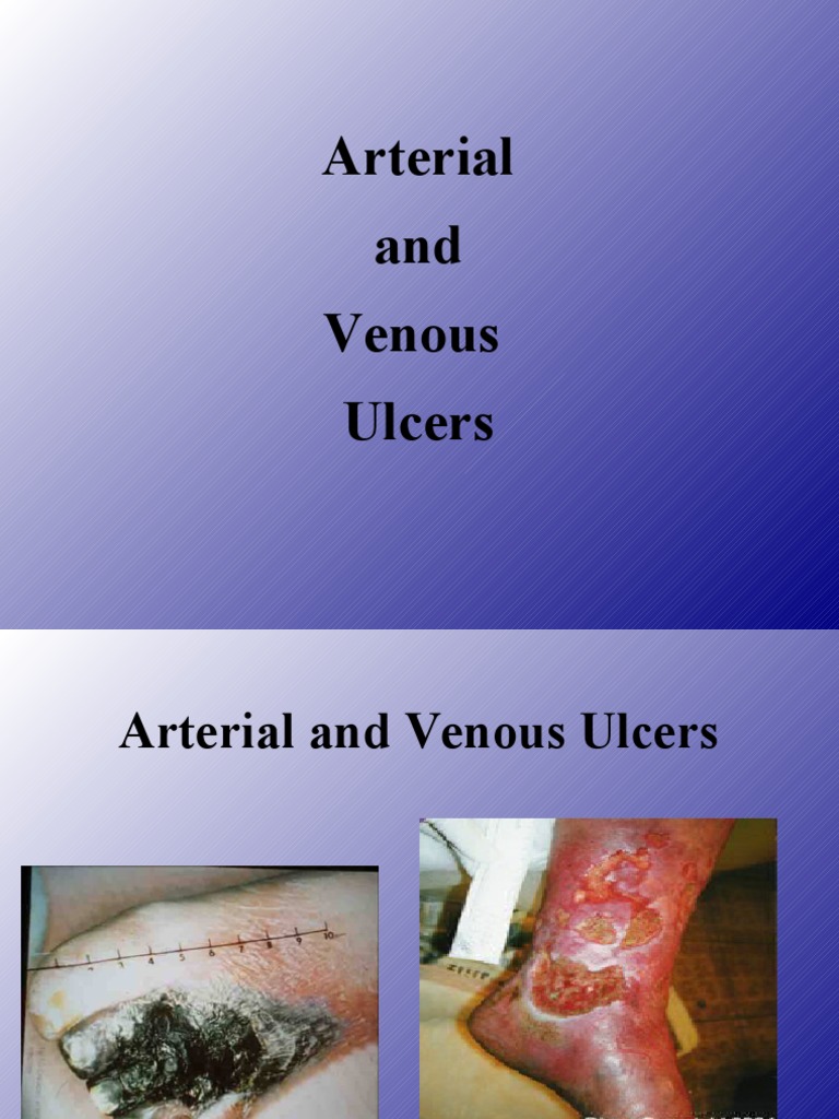 4 - Arterial & Venous Ulcers | PDF | Vein | Wound