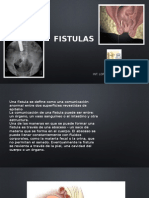 Fistulas