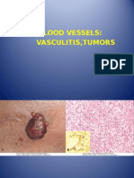 BV Vasculitis Tumors