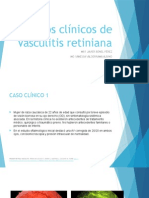 Casos Clínicos de Vasculitis Retiniana