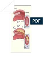 Aterosesclerosis PDF